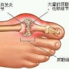 痛风如何治疗？正确泡脚可治疗痛风